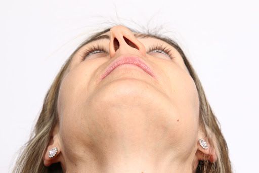 rhinoplastie