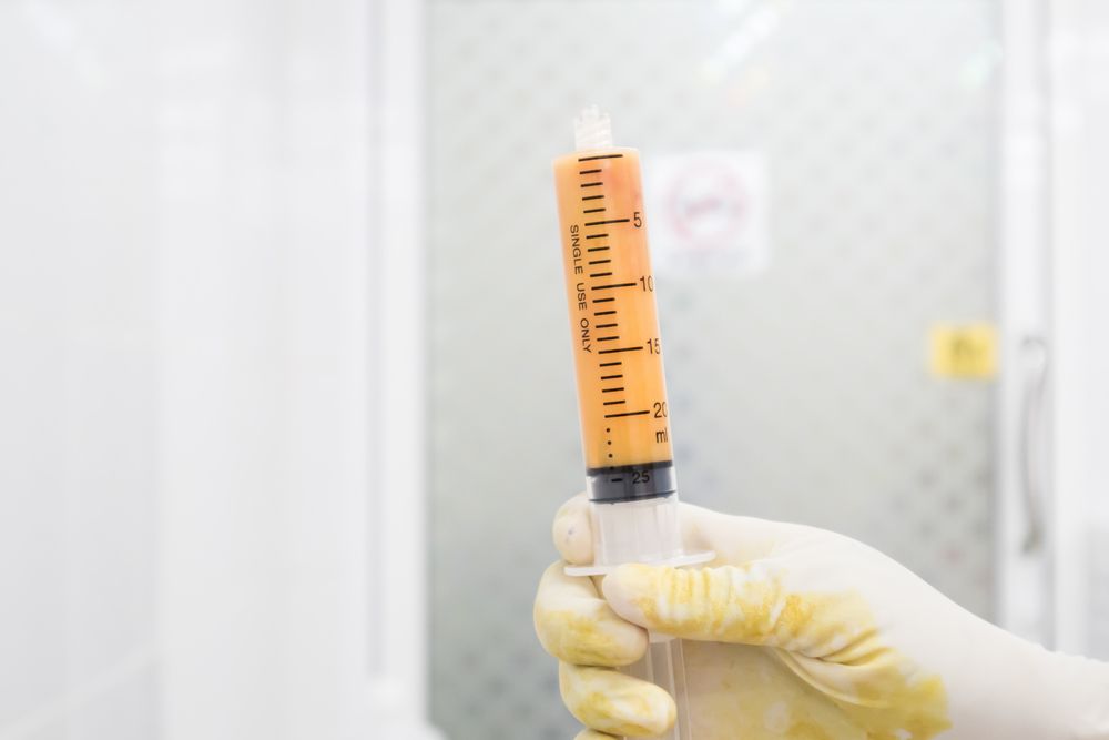 Liposuccion : attentes et réalité