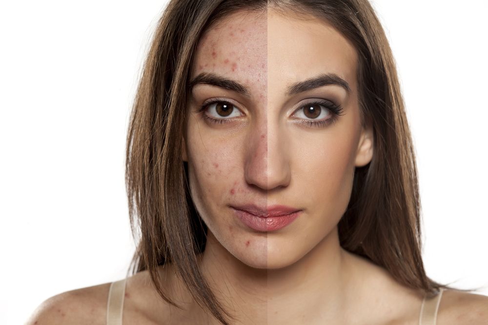 types de laser pour le visage