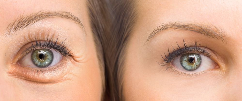 Qu’est-ce que la blépharoplastie laser Plexr ?