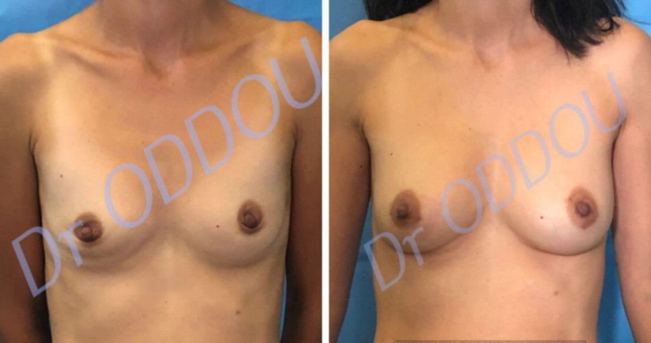 Avant après lipofilling mammaire