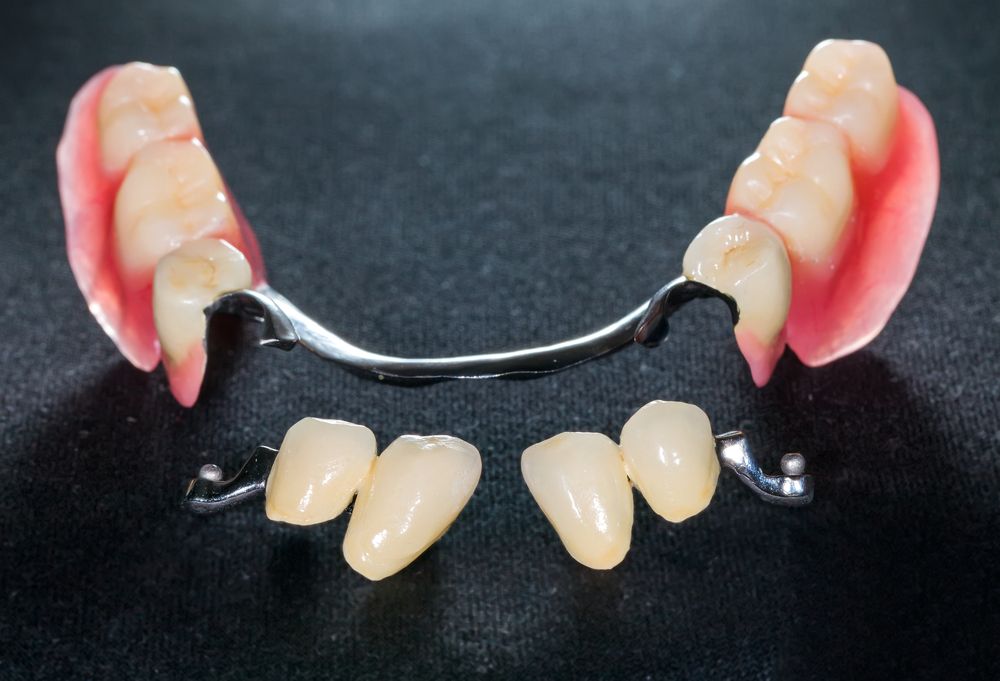 implants dentaires