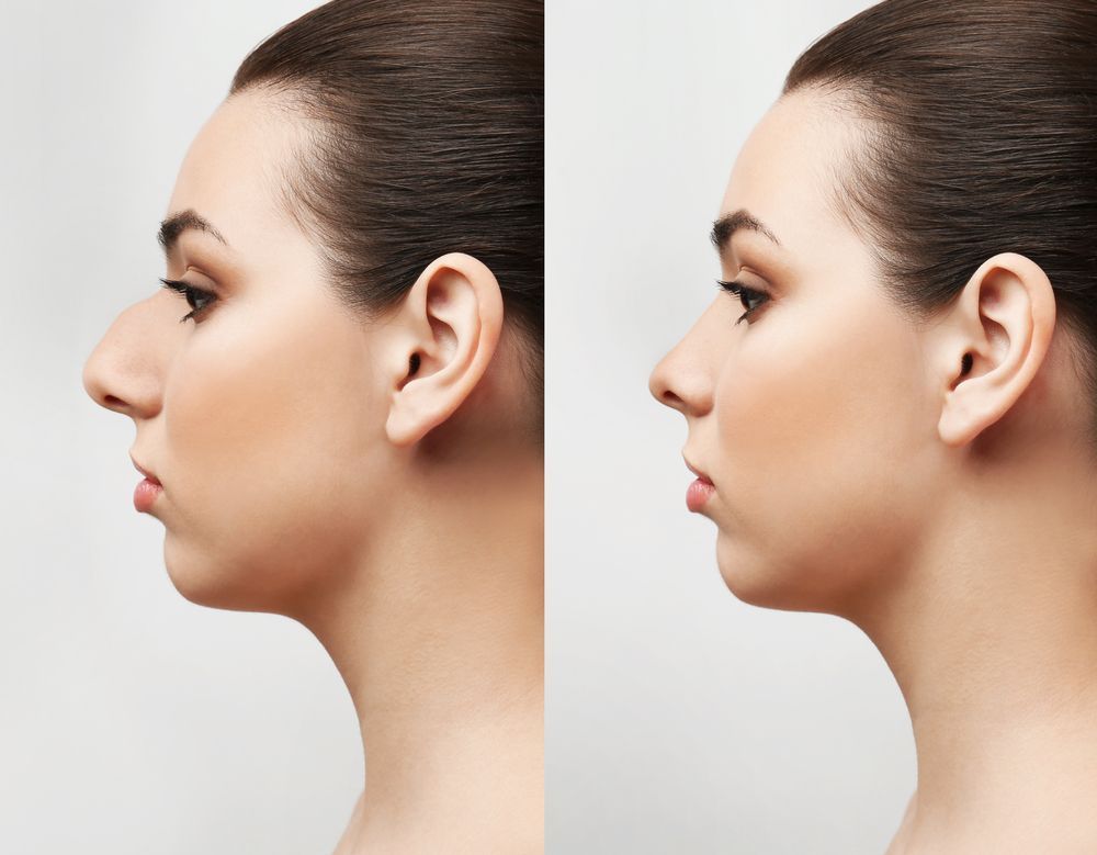 post rhinoplastie