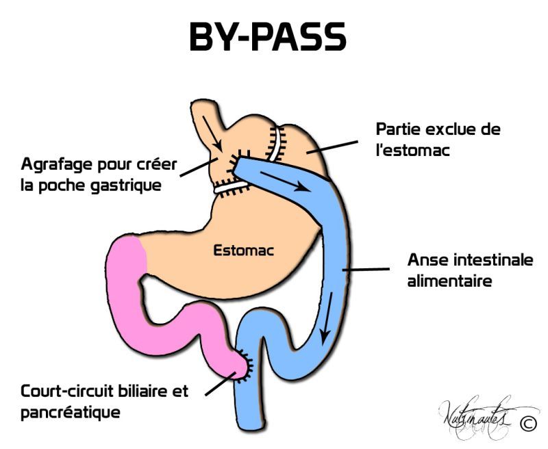 Le bypass à la loupe Multiesthetique.fr