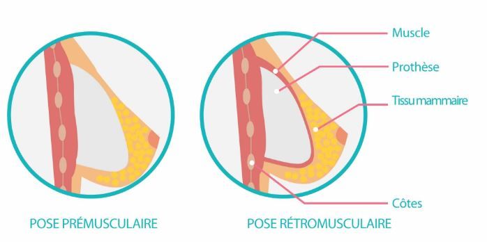 Les implants mammaires, au-dessus ou en-dessous du muscle ...