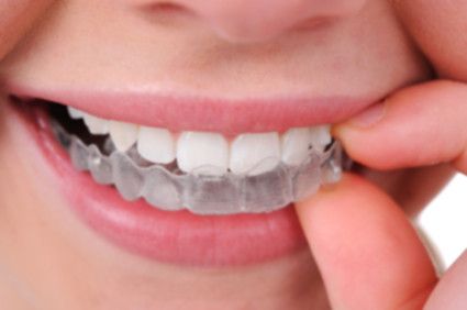 orthodontie invisible