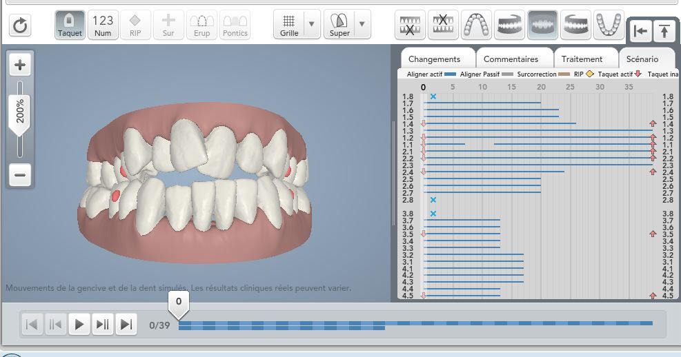 orthodontie invisible