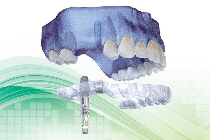 guide-implants-dentaires-photo-2.jpg