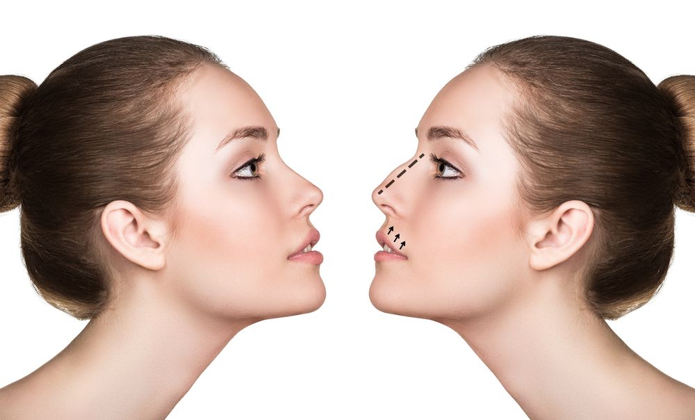 rhinoplastie soins
