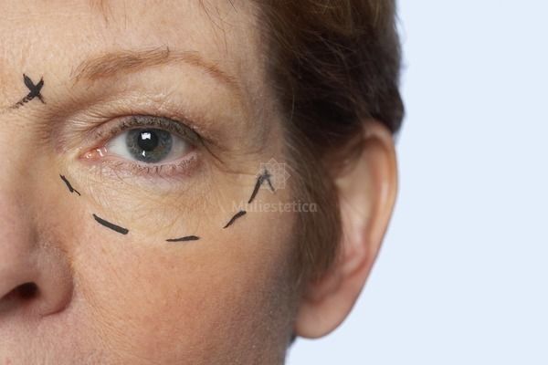 La blépharoplastie laser