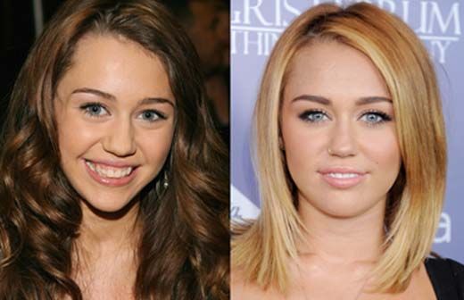 la-rhinoplastie-photo-5.jpg