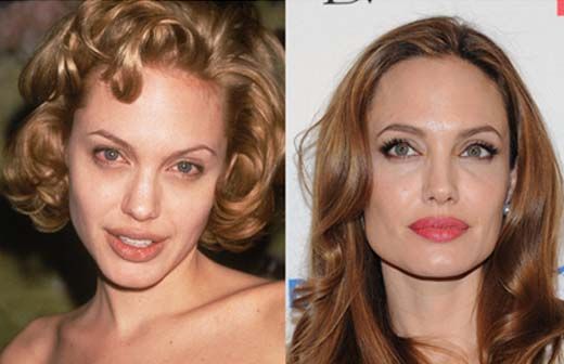 la-rhinoplastie-photo-7.jpg
