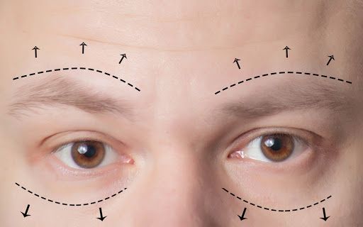 blépharoplastie