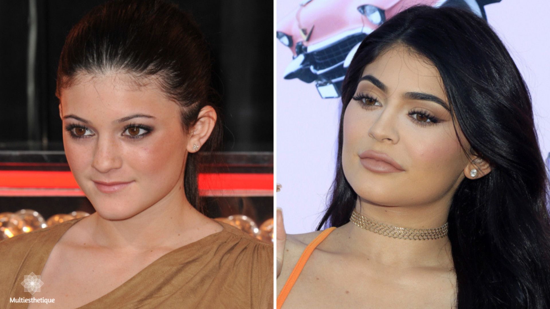 Avant Après Kylie Jenner Canthopexie
