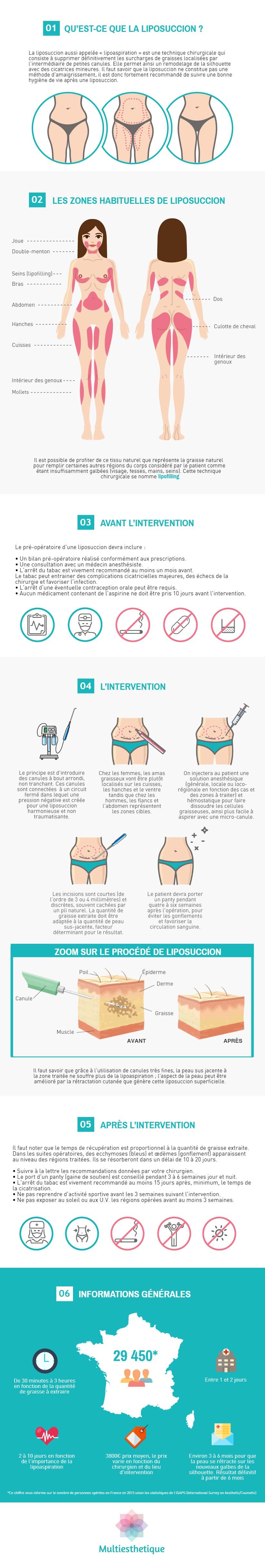 infographie liposuccion